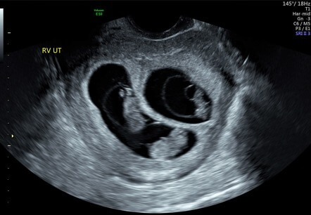 Prenatal ultrasonography in twins
