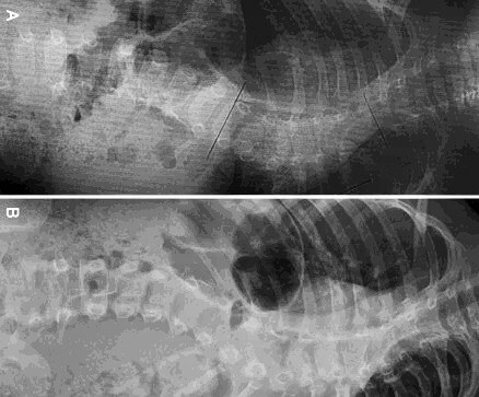 Congenital scoliosis