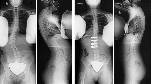 idiopathic scoliosis