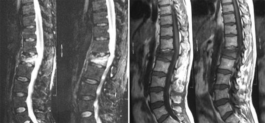 Kyphoplasty indications