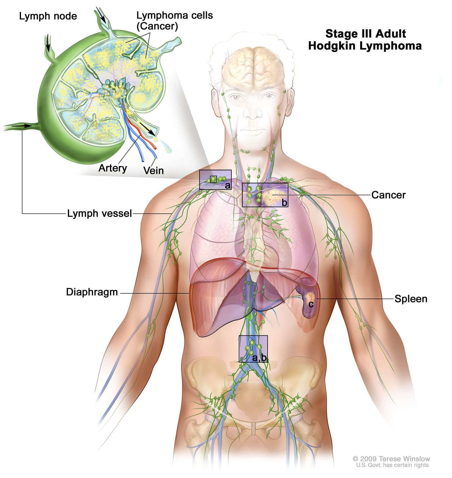 AIDS-Related Non-Hodgkin Lymphoma