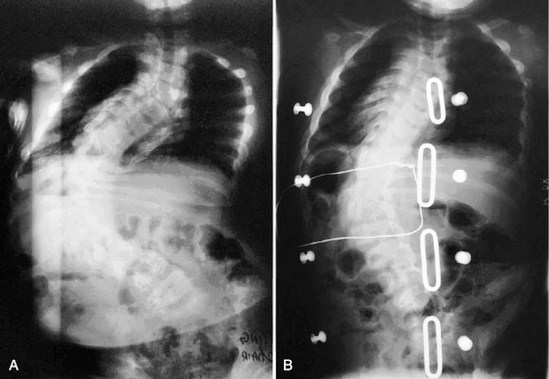 Neuromuscular scoliosis