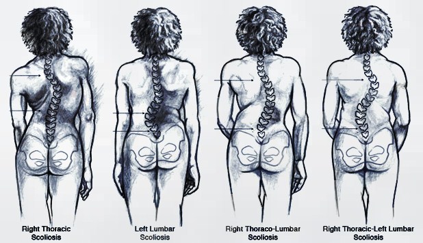 Scoliosis symptoms