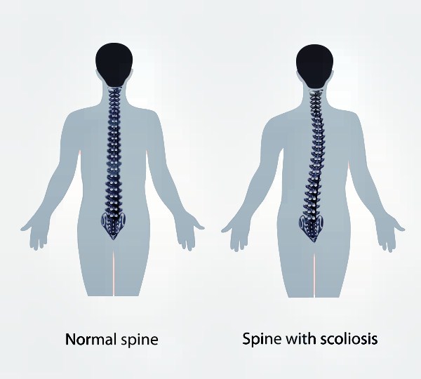 Scoliosis treatment