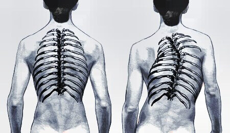 what is scoliosis and types of scoliosis